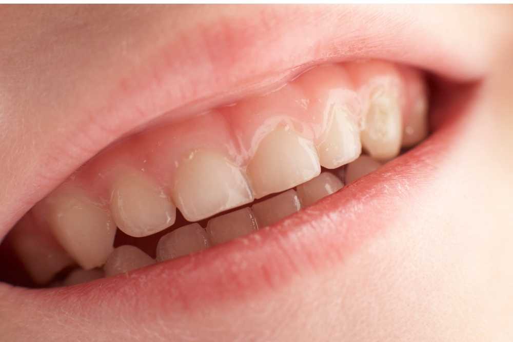 How To Remove Yellow Stains From Child's Teeth?